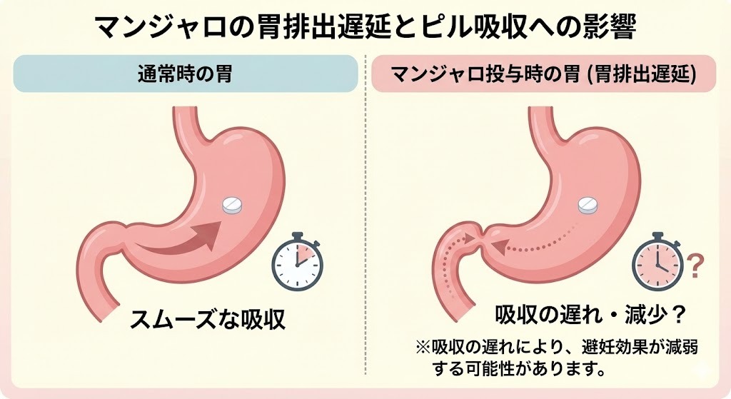 マンジャロによる胃排出遅延が経口避妊薬（ピル）の吸収に与える影響を示す図解。通常時とマンジャロ投与時の胃の様子を比較し、吸収の遅れや減少の可能性をイラストで解説している。