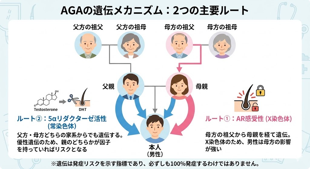 AGAの遺伝メカニズム家系図(母方の祖父からのX染色体遺伝と、両親双方からの常染色体遺伝の2ルートを示す簡略図)