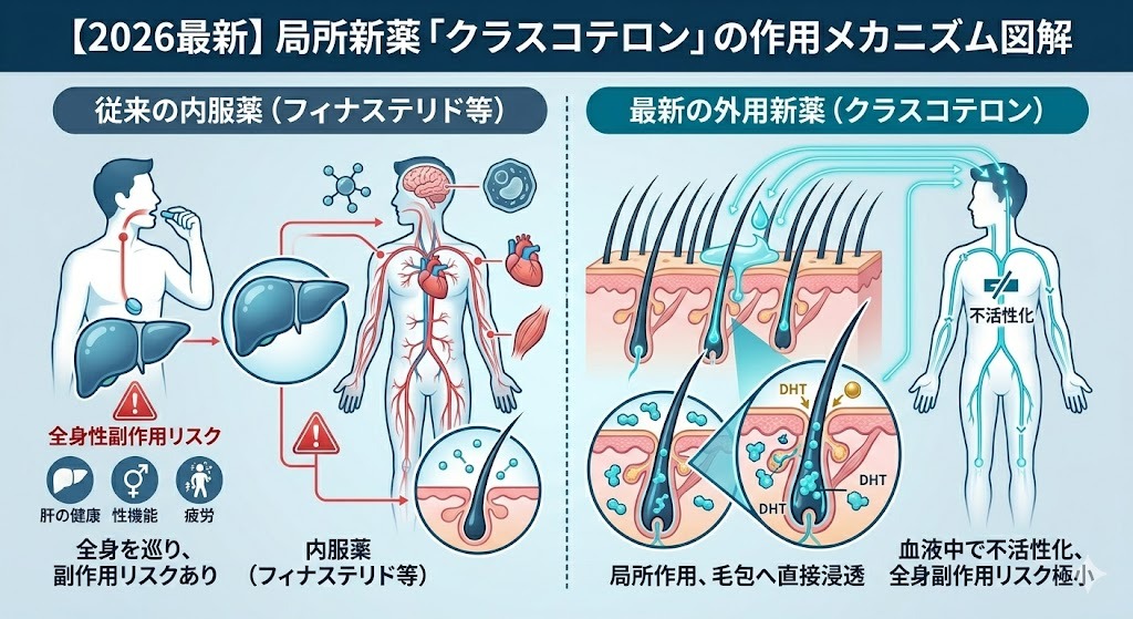 2026年最新のAGA新薬「クラスコテロン」の局所作用メカニズムを、従来の内服薬(全身副作用リスクあり)と比較したインフォグラフィック。クラスコテロンは頭皮(毛包)に塗布されDHTを阻害し、体内で速やかに不活性化するため全身副作用が極小であることを図解。