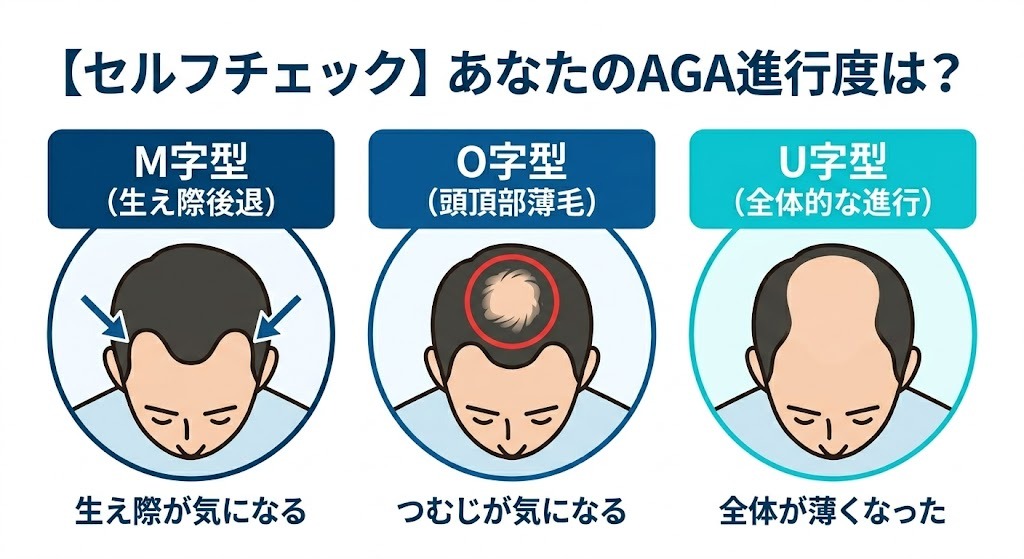 M字型、O字型などAGA（薄毛）の進行パターンと適した治療薬の組み合わせ