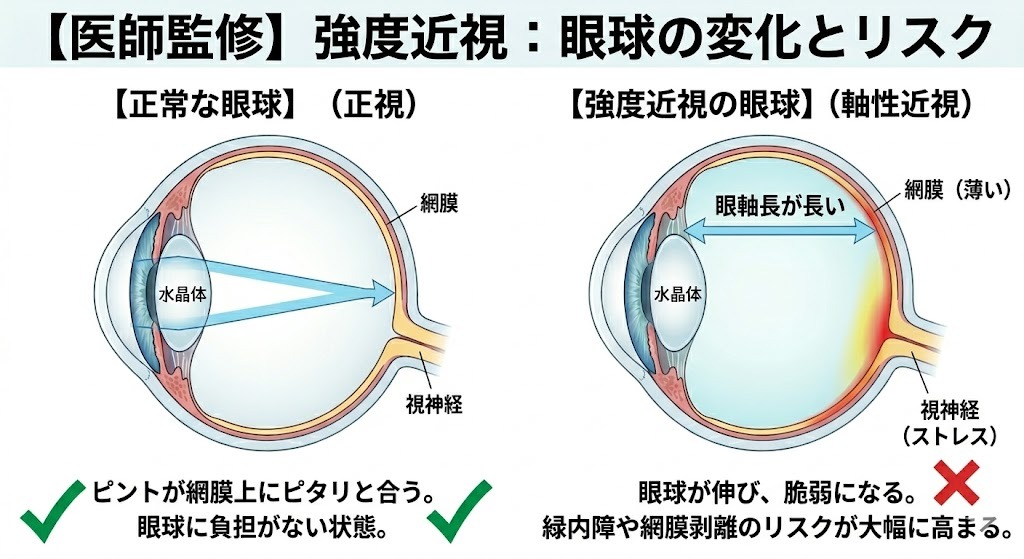 強度近視と正常な眼球の比較図解。強度近視は眼球の奥行き（眼軸長）がラグビーボールのように伸びており、奥の視神経が薄く引き伸ばされるため、緑内障などのリスクが高い。